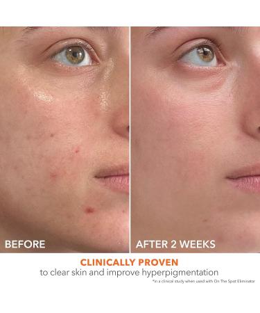 Dr Dennis Gross Alpha Beta 2% BHA+ Breakout Solution - Minimize Pores & Prevent Breakouts - 5 Fl Oz | International Shipping Available - Buy Online on GoSupps.com