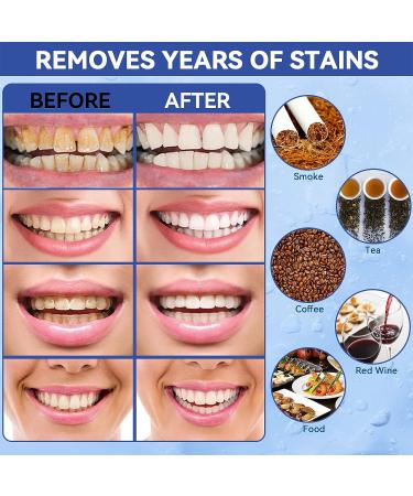 Teeth Whitening Pen (4 Pens) | Fast Results, No Sensitivity | Professional Tooth Whitening Gel Kit for Bright White Smile | Oral Care Stain Remover - Buy Online on GoSupps.com