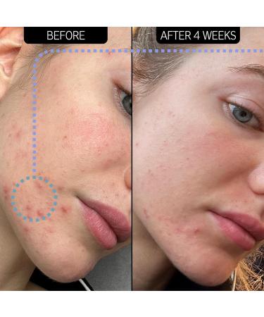 Buy INKEY List SuperSolutions Novoretin 2% Moisturizer - Skin Clearing Blemish Reduction Non-Comedogenic - International Shipping Available - Buy Online on GoSupps.com