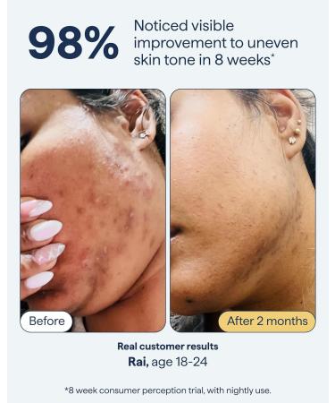 Remedy for Dark Spots | Advanced Night Treatment with Retinol & Kojic Acid | For Discoloration and Uneven Tones | With Glutathione Niacinamide Mandelic Acid | By Dermatologist Dr. Shah 1 fl. oz - Buy Online on GoSupps.com