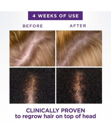 Head & Shoulders Scalp X 2% Minoxidil for Women - Hair Regrowth Treatment Thinning Hair & Hair Loss Solution 3 Month Supply (3 x 2 Fl Oz - Buy Online on GoSupps.com