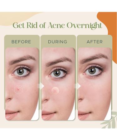 Advanced Hydrocolloid Acne Patches (36 Pcs) - Drug-Free Spot Treatment for Clear Skin - Fast Acting Blemish Remover & Camouflaging Solution - Buy Online on GoSupps.com