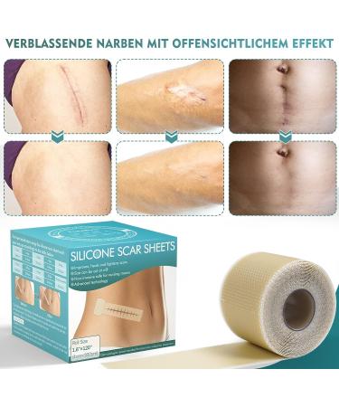 Silicone Scar Sheets Roll - Reusable Scar Removal Tape for Old & New Scars (1.6 x 120 inches) - Buy Online on GoSupps.com