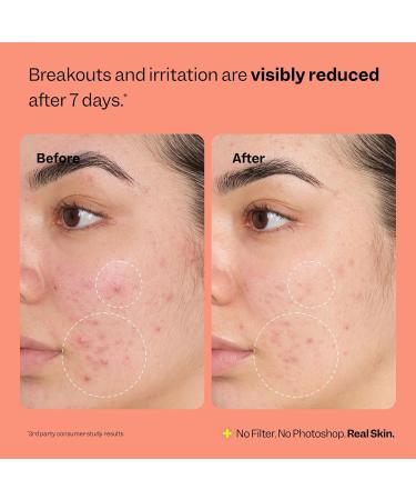 Peach Slices - Fix All Recovery Spray (4 oz) - Purify Soothe & Relieve - Zits Stressors & Redness - Hypochlorous Acid Spray - Electrolyzed Water - Vegan & Cruelty Free - Korean Skin Care & Beauty - Buy Online on GoSupps.com