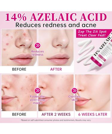 14% Azelaic Acid Acne Cream with Niacinamide & Centella Azelaic Acid Facial Serum Smooth & Even Skin Tone Reduce the Appearance of Blemishes Dark Spots & Uneven Skin Gentle Hydrating Formula 1.4oz 1.4 Fl Oz (Pack of 1) - Buy Online on GoSupps.com