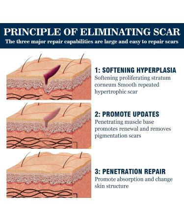  ZRREMRE Anti Scar Cream Repair Gel for Old and New Scars Face Scar Treatment Cream Surgical Scars Acne Scars Caesarean Section  - Buy Online on GoSupps.com