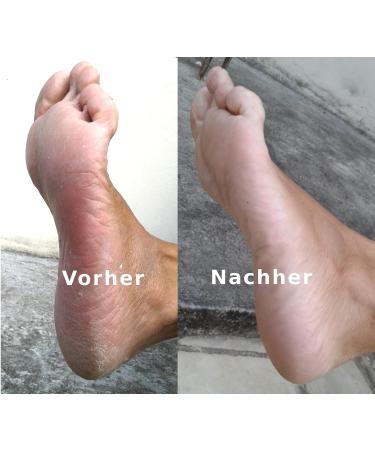 Buy Mosadal Foot Bath - Effortless Callus Removal & Foot Care | International Shipping Available - Buy Online on GoSupps.com