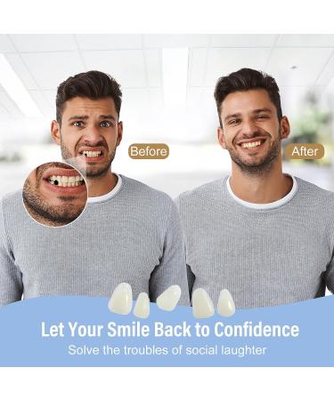 Fake Teeth Repair Kit - Moldable False Tooth for Fixing Broken & Missing Teeth - Natural Look - Set of 60 - Buy Online on GoSupps.com