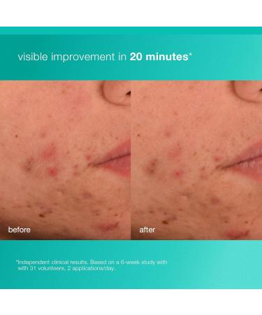 Dermalogica Acne Biotic Face Moisturizer Lightweight Daily Lotion - Helps with Aging Skin and Prevents Breakouts 1.7 fl oz - Buy Online on GoSupps.com