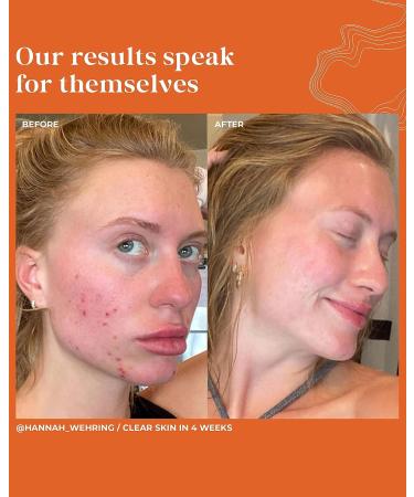 Terasana Clinical Clear + Control Face Serum | All-Natural Vegan Spot Treatment (1 FL OZ) - Buy Online on GoSupps.com