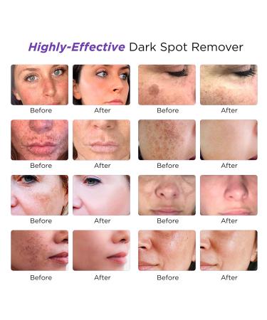 Dark Spot Remover Serum for Face & Body | Age Sun Spots, Freckles, Melasma Treatment | 4-Butylresorcinol, Kojic Acid, Hyaluronic Acid - 50ml - Buy Online on GoSupps.com