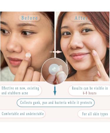 Buy 72 Pimple Patches with Triple Oil Infusion - Salicylic Acid Tea Tree & Centella Oil for Acne Relief - Fast International Shipping - Buy Online on GoSupps.com