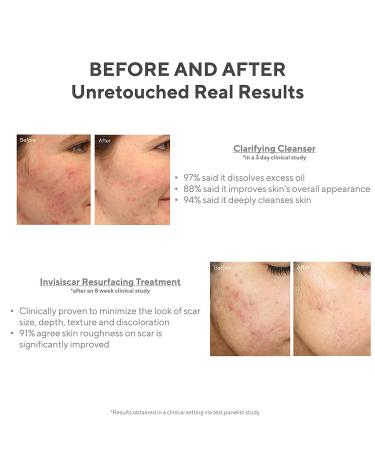 Murad Acne Control Kit: 30-Day Trial Breakout Skin Care with InvisiScar Resurfacing Treatment - Buy Online on GoSupps.com