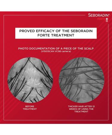 Seboradin Hair Loss Lotion for Men & Women - 200ml | Natural Extracts Vitamins and Scalp Care for Hair Growth - Buy Online on GoSupps.com
