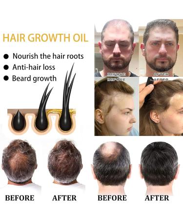 Hair Serum for Hair Growth Ginger Hair Regrowth Serum Ginger Hair Growth Oil for Thinning Repair Hair Follicles Hair Growth Oil for Hair Rapid Growth and Thickening Trengthen Hair Roots 20ML - Buy Online on GoSupps.com