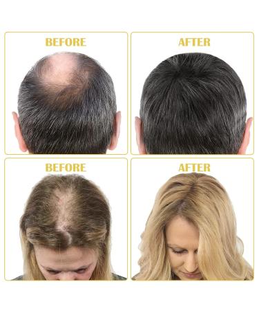 5% Minoxidil Hair Growth Serum - Scalp Treatment for Hair Loss & Thinning - Unisex - Promotes Thicker Fuller Healthier Hair - Buy Online on GoSupps.com