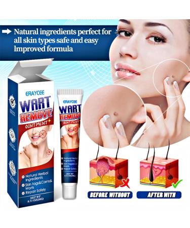 Wart Removal Cream 20g Effective Treatment of Warts Corns Spot Moles Moles and Calluses Suitable for The Face and Body to Prevent The Spread of Warts - Buy Online on GoSupps.com