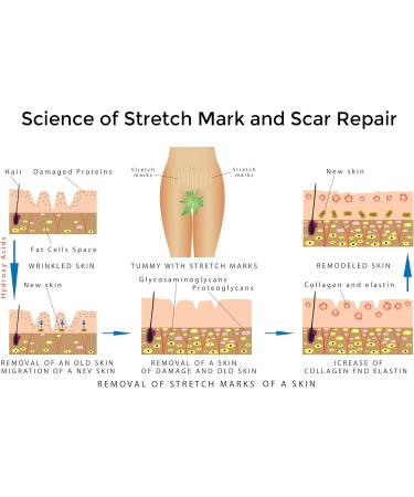 Best Stretch Marks Cream - Prevent & Reduce Pregnancy Marks | Highly Concentrated Formula + Free $29 Scar Reducing Guide - International Shipping Available - Buy Online on GoSupps.com