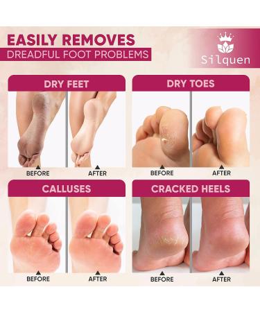 Pack of 1 Professional Pedicure Foot File of Good Plastic and Steel Grades Remove Callus Hard Skin Remover Double-Sided Exfoliator-Scrubber Easy to Use with Ergonomic Grip - Buy Online on GoSupps.com