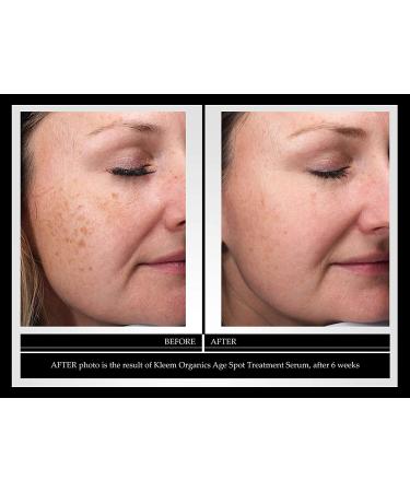 Kleem Organics Dark Spot Corrector Serum for Face, Hands & Neck - Bio-Formulated Age, Sun & Dark Spot Remover - Made in USA - Buy Online on GoSupps.com