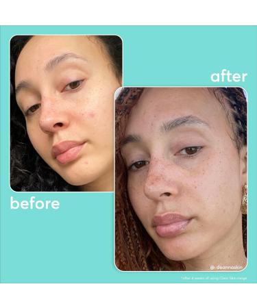 Super Facialist On The Spot Clarifying Gel - Spot Treatment for Acne with 10% Niacinamide Tea Tree Oil & Prebiotics Vegan Friendly 15ml - Buy Online on GoSupps.com