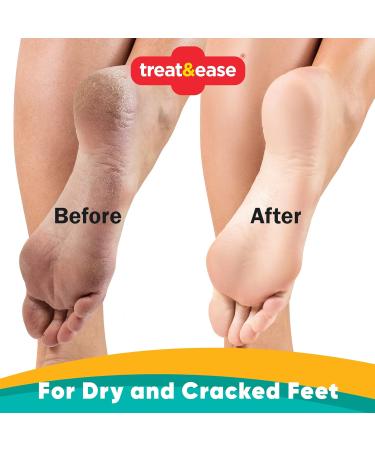 2pk Moisturising Foot Cream for Cracked Heels and Dry Skin | 200g | Dry Foot Cream for Very Dry Feet & Cracked Heel Repair Cream | Heel Balm for Cracked Heel Cream Foot Balm Feet Cream + SOL Sticker - Buy Online on GoSupps.com