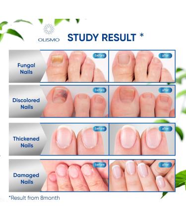 Extra Strength Toenail Fungus Treatment 30ML - Fast Relief for Men & Women | Nail Fungus Cure - Buy Online on GoSupps.com