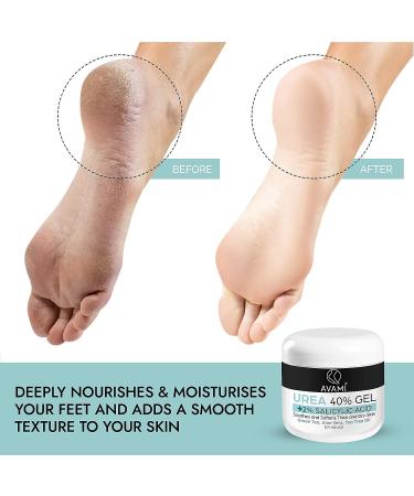 AVAMI 40% Urea Gel with Salicylic Acid, Tea Tree & Aloe Vera - Softens Dry Skin, Heals Cracked Heels & Calluses (Set) - Buy Online on GoSupps.com