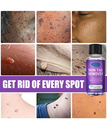 Skin Tag Mole Removal 30ML - Natural Wart Remover & Corrector for Face and Body - Buy Online on GoSupps.com