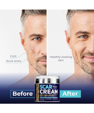 Advanced Scar Cream for Face and Body - Acne & Surgery Scar Treatment - Vitamin E, Silicone-Free Formula - All Skin Types - Buy Online on GoSupps.com