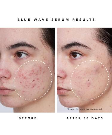 HERBIVORE Blue Wave Clearing Serum | Acne Treatment with 2% Salicylic Acid Blue Tansy & Willow Bark | Plant-Based Vegan Cruelty-Free | 30mL - Buy Online on GoSupps.com