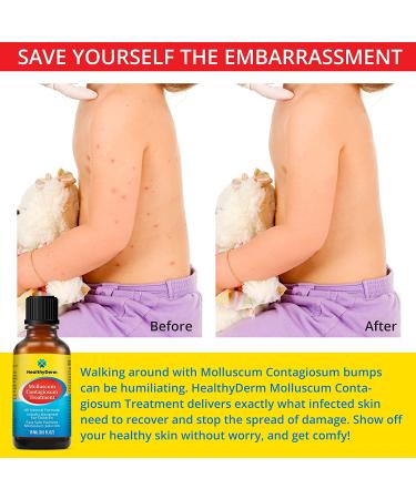 Molluscum Contagiosum Treatment: Fast, Safe, Painless Solution for Children and Adults - 1 Month Supply by HealthyDerm - 15mL / 0.5 Fl Oz - Buy Online on GoSupps.com