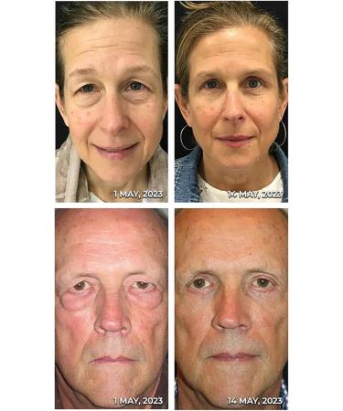 Milk spots soothe electric serum pen Eye cream Electric serum Electric serum pen Moisturizing Anti-aging cream to reduce milk spots and sagging eyes - Buy Online on GoSupps.com