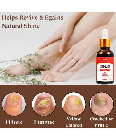 Fungal Nail Treatment for Toenails - Extra Strong 30ml Formula - Safely Reclaim Healthy Nails - Buy Online on GoSupps.com