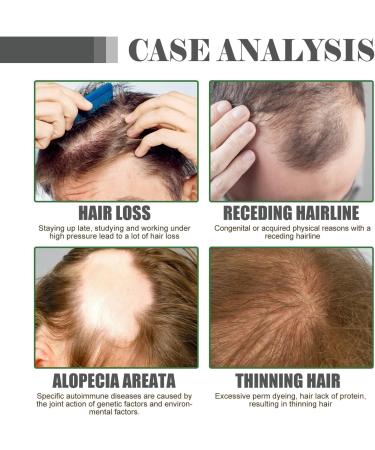 Hair Growth Serum Anti Hair Loss Hair Serum Rosemary Essential Oil With Ginseng And Castor Oil Extracts Repairs Hair Follicles Stronger Hair Hair Growth Oil for Women & Men 35ml - Buy Online on GoSupps.com