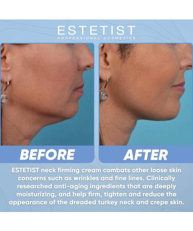 ESTETIST Caffeine Infused Eye Lift Cream - Brightens Dark Circles, Firms Under Eye Bags, & Tightens Sagging Skin - Neck & Chest Firming Cream - Buy Online on GoSupps.com