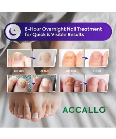 Accallo Extra Strength Toenail Fungus Treatment Patches - 32 Nighttime Renewal Patches for Nail Fungus Relief - Buy Online on GoSupps.com