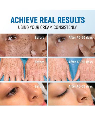 Dark Spot Remover for Face & Body - Vitamin C Niacinamide & Collagen - Skin Lightening Cream for Men & Women - 43% Active Ingredients - Dark Spot Corrector & Brightening Cream - Buy Online on GoSupps.com
