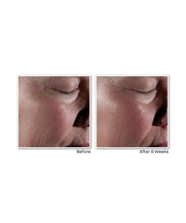 RoC Retinol Correxion Max Wrinkle Anti-Aging System - Hyaluronic Acid Serum for Fine Lines, Dark Spots & Acne Scars - Set of 2 Resurfacing Serums - Buy Online on GoSupps.com