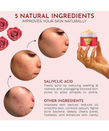 Acne Face Cream with Salicylic Acid | Cystic Acne Treatment for Face & Body | Anti-Acne Skincare for Teens & Adults | 3.53 OZ - Buy Online on GoSupps.com