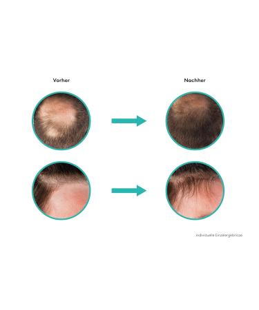Re-Actin Hair Growth Activator Tonic 100ml - Boost Hair Growth | Fast Shipping Worldwide - Buy Online on GoSupps.com