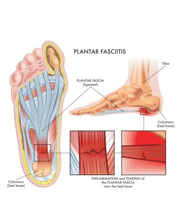 Arnica skin care Cream & Plantar Fasciitis Patches - Buy Online on GoSupps.com