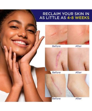 Silicone Scar Sheets - Treating Keloid, C-Section, Tummy Tuck - Surgical Gel Patch Bandage - Transparent Reusable Breathable - Buy Online on GoSupps.com