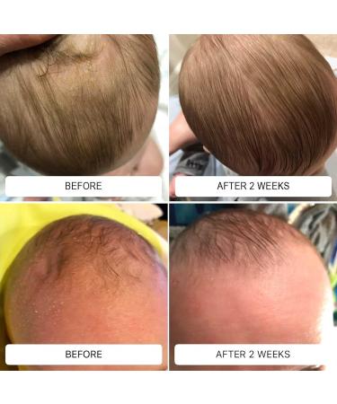 Happy Cappy Daily Medicated Shampoo and Body Wash Bundle - Baby Dandruff Shampoo, Helps Cradle Cap and Seborrheic Dermatitis, Reduces Redness, Dermatologist Tested, Fragrance-Free - 4 Pieces Bundle 8 Fl Oz (Pack of 4) - Buy Online on GoSupps.com