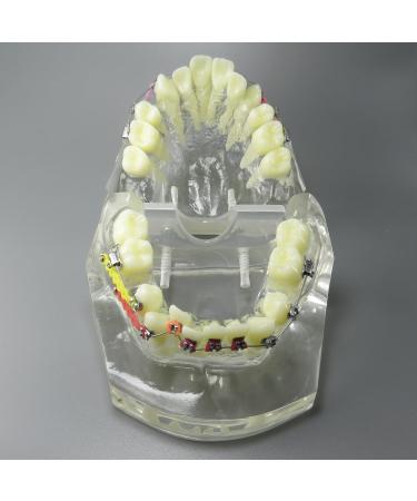 Shop Dental Malocclusion Orthodontic Treatment Model - Metal Brackets & Colorful Ties | M3005 - International Shipping Available - Buy Online on GoSupps.com