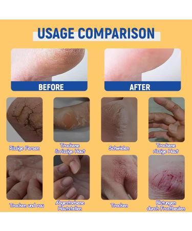 MrCuvaryas Hydrating and Anticracking foot cream 60 urea foot cream very dry feet heel balm relieves itching for elbows knees feet and hands urea cream with foot file blue 40 g + 40 g - Buy Online on GoSupps.com