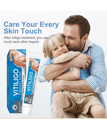 UpdateClassic Vitiligo Cream | Natural Vitiligo Treatment for Skin | Reduce White Spots & Improve Pigmentation | Easy to Use | Blue/Vitiligo - Buy Online on GoSupps.com