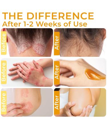 Rida Hair Research Institute Psoriasis Cream for Itchy Scalp, Face & Body | Eczema, Seborrheic Dermatitis, Anti Itch Cream Extra Strength, Jock Itch - Buy Online on GoSupps.com