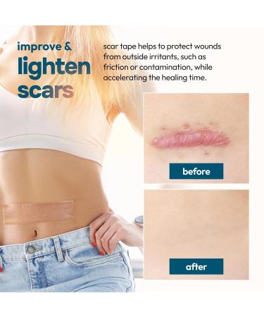 Reusable Silicone Scar Tape Sheets (120 x 1.6 ) - Medical Grade Treatment for Surgical Scars Keloids & Burns - Customizable for Tummy Tucks & C-Sections - Buy Online on GoSupps.com