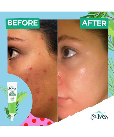 St. Ives Spot Treatment with 2% Salicylic Acid & Tea Tree Extract 0.75 oz - Reduce Blemish Redness, Control Acne - Buy Online on GoSupps.com
